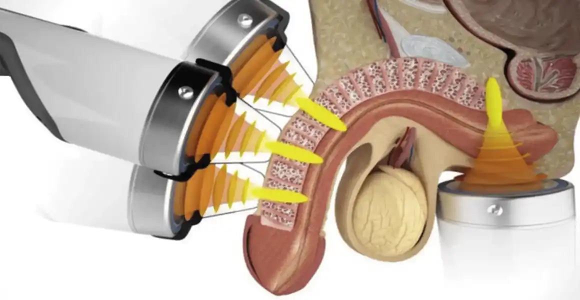 ESWT Cinsel Tedavi İçin Nasıl Kullanılır