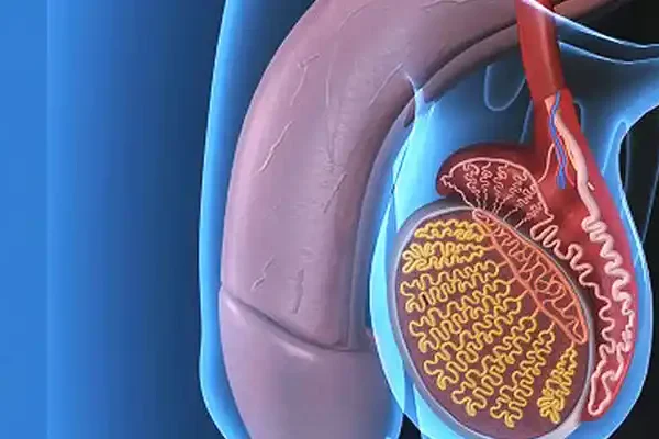Varikosel Olan Biri Ne Yapmalı